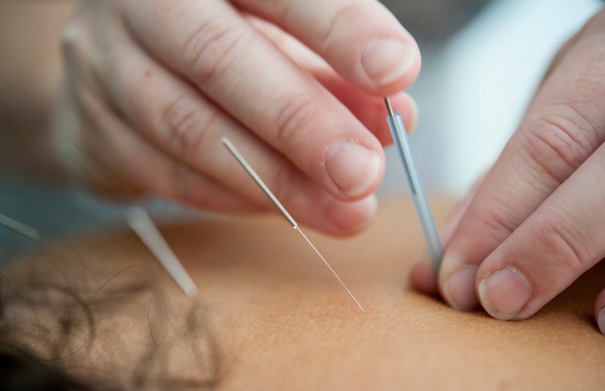 Acupuncture treatment in Fort Lauderdale, FL